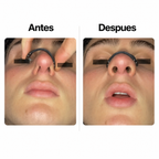 Dilatador Nasal Magnético ZENNT