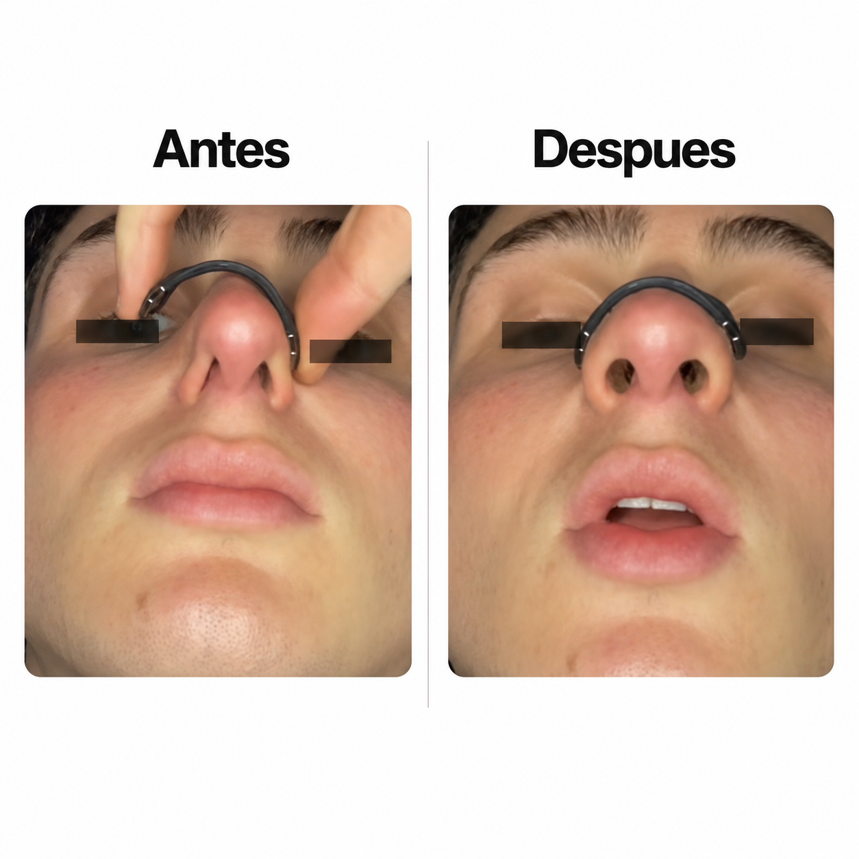 Dilatador Nasal Magnético ZENNT